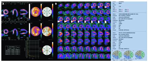 Panel A Dynamic Myocardial N Ammonia Pet Ct In A Normal Patient