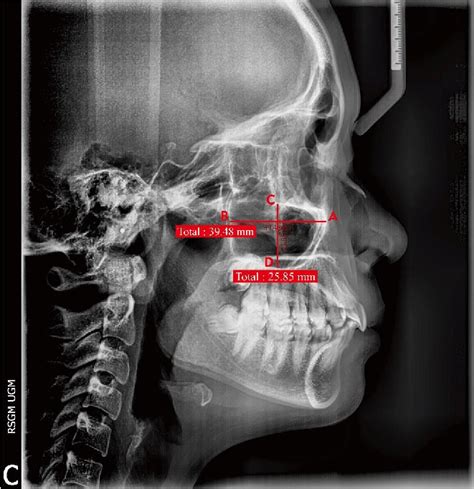 Measurement Of The Width And The Height Of The Maxillary Sinus On The