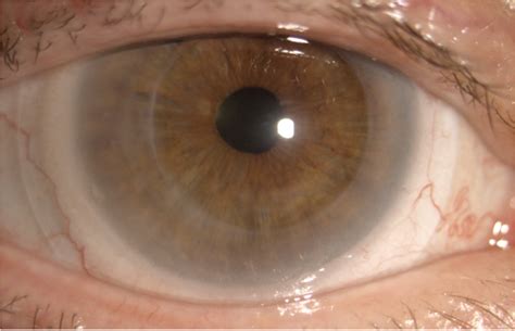 Type 1 Lattice Corneal Dystrophy Status Post Penetrating Keratoplasty