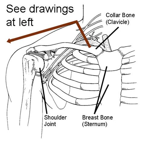 Sternoclavicular Arthritis Dr Skedros Orthopaedics