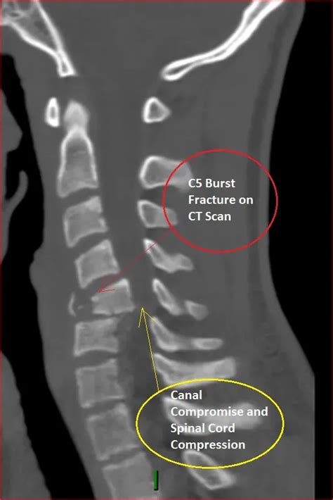 Case Studies Series: Cervical Spine Fracture | Neurosurgeons located in Long Beach, CA | Coast ...