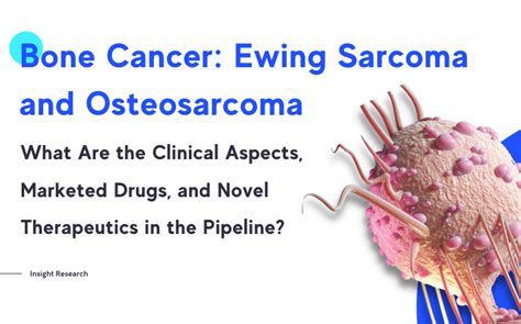 Ewings Sarcoma Vs Osteosarcoma