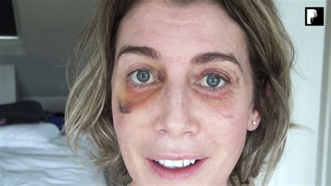 Fantastic Blepharoplasty Gone Wrong Photos Access Here