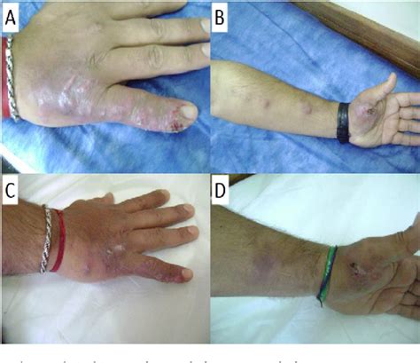 Figure 1 from Genotyping and clonal origin of Sporothrix brasiliensis ...