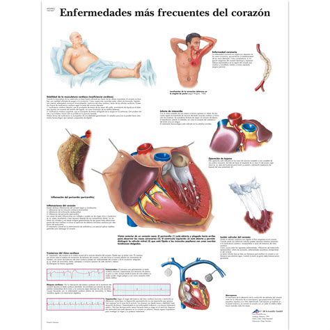 Enfermedades Más Frecuentes Del Corazón Lámina Anatomical 3d