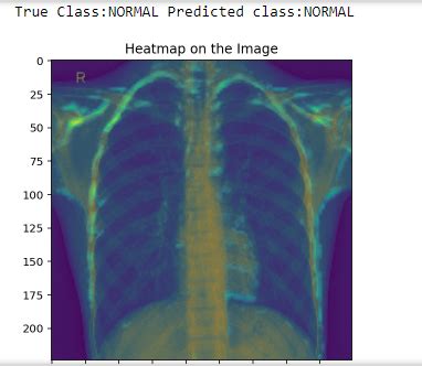 GitHub - Krishvraman/Pneumonia-classification-chest-X-rays