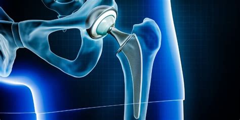 The 10 Most Common Types Of Hip Replacement Surgery The Orthopedic Clinic