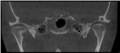 Diagnostyka stawów skroniowo żuchwowych SSŻ w Pracowni 3D tomografia