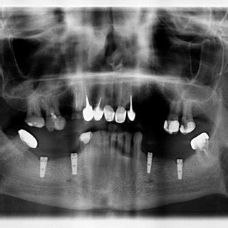 Orthopantomogram of patient S.D. after final implantation procedure. | Download Scientific Diagram