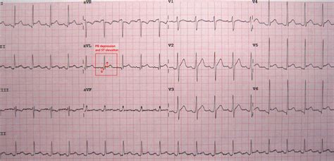 Constrictive Pericarditis Ecg