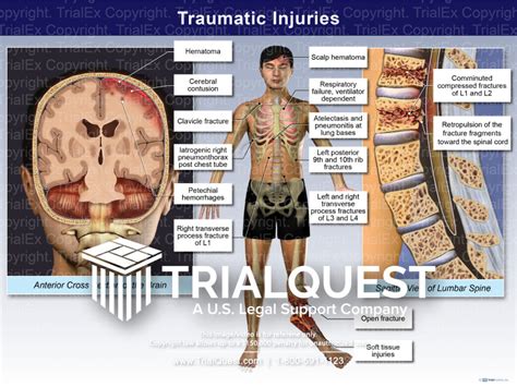 Traumatic Injuries Trial Exhibits Inc