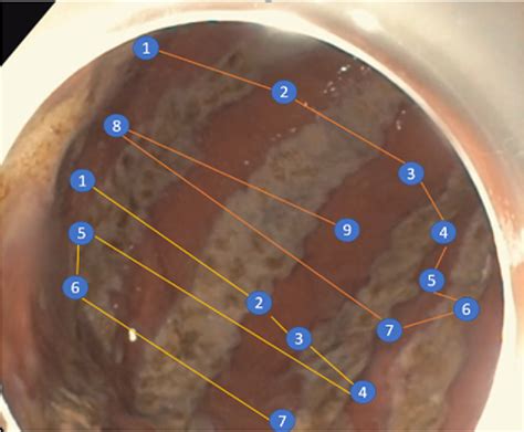 Figure From Argon Plasma Coagulation Prior To Endoscopic Sleeve