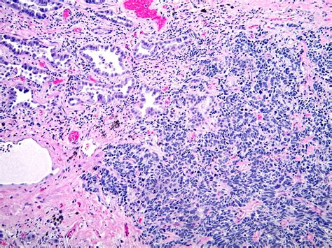 Small Cell Carcinoma Combined With Adenocarcinoma Small Ce… Flickr