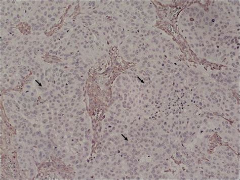 Negativo Para Células Neoplásicas - Encéfalo: células neoplásicas com imunomarcação negativa para vimentina ...