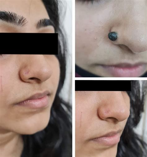 Mole Removal Surgery (Treatment) in Kandivali, Borivali & Malad