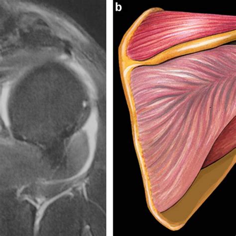 Axial Mri Image Of Infraspinatus Musculotendinous Rupture A Acute