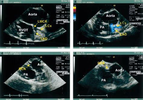 Orientation Of The Intracardiac Echocardiographic Catheter And The