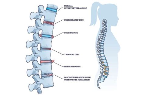 Degenerative Disc Disease - SpineCare Singapore