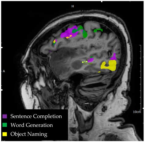 Wernickes Area Fmri