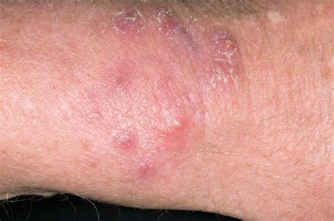 Fungal Skin Rash