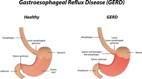 GERD causes inflammation – Newport Natural Health