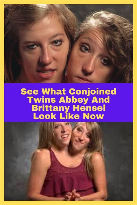 See What Conjoined Twins Abbey And Brittany Hensel Look Like Now Conjoined Twins Twins Brittany