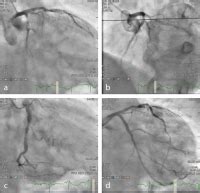 Abbildungen Und Graphiken EKG Beispiel Infarktdiagnostik Bei