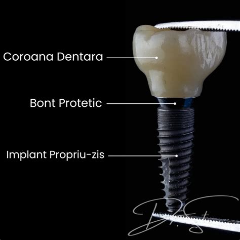 Implant Dentar Componente Implant Bont Si Coroana