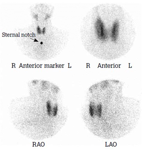 Nuclear Medicine Thyroid Uptake And Scan Top 3 Things To Know