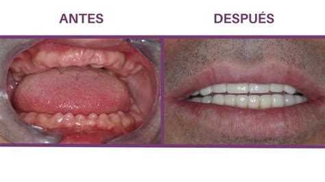 Cu Les Son Los Mejores Implantes Dentales Para Ti Clinicaforumdental