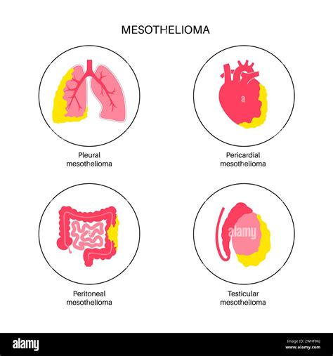 Mesothelioma Tumour Types Illustration Stock Photo Alamy