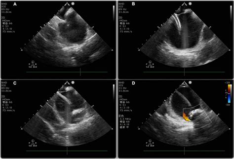 Intracardiac Echocardiography Guided Cryoablation A ICE Guided Low