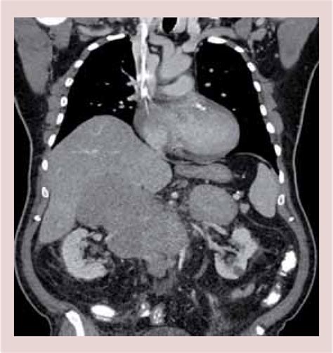 Figure 1 from Rare transformation to double hit lymphoma in Waldenstrom ...