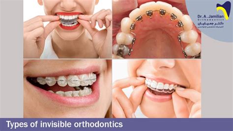 Types Of Invisible Orthodontic Dr Jamilian