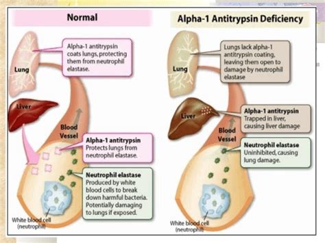 Cirrhosis In Children