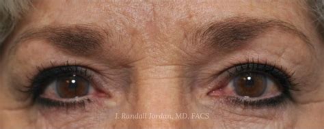 Blepharoplasty Case Faces Pllc In Ridgeland Ms