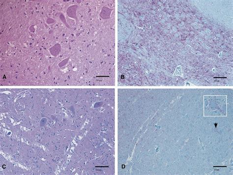 Histopathology And Ihc On Brain Samples From Us Bse Cases In Both