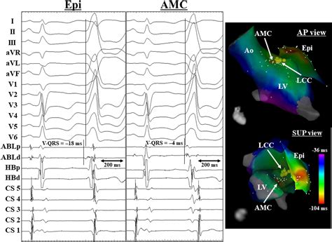 Predictors Of Successful Endocardial Ablation Of Epicardial Left