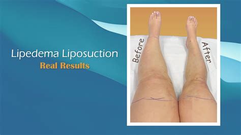 Before And After Lipedema Liposuction Expert Dr Thomas Su Youtube