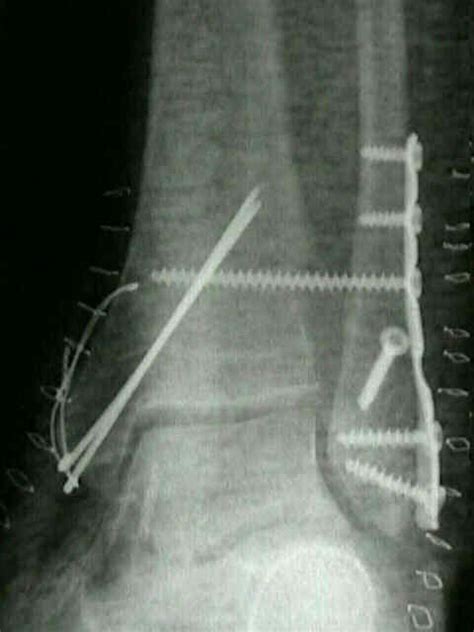 Medial Malleolar Fractures Wheeless Textbook Of Orthopaedics