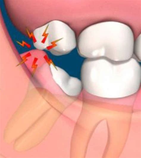 Qué es la pericoronaritis Periocoronitis de la muela del juicio