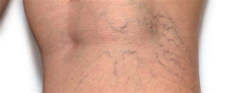 Spider Vein Treatments in NY - Clear Skin Awaits!