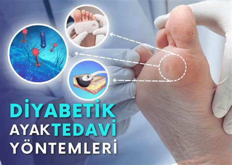 Diyabetik Ayak Tedavi Y Ntemleri Turan Turan