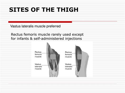 Rectus Femoris Injection Site