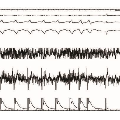 A Intracardiac Electrogram Showing Bipolar Prepotential Preceding The