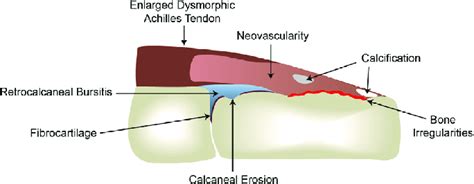 Representative changes at the Achilles enthesis organ. | Download Scientific Diagram