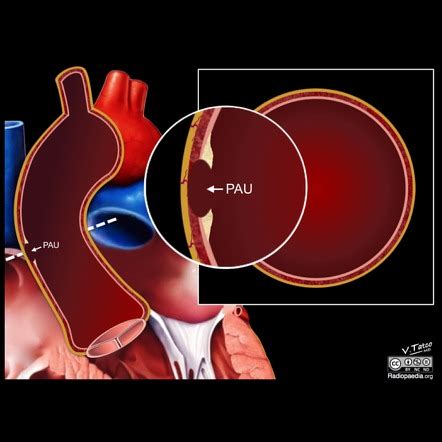 Penetrating atherosclerotic ulcer | Radiology Reference Article ...