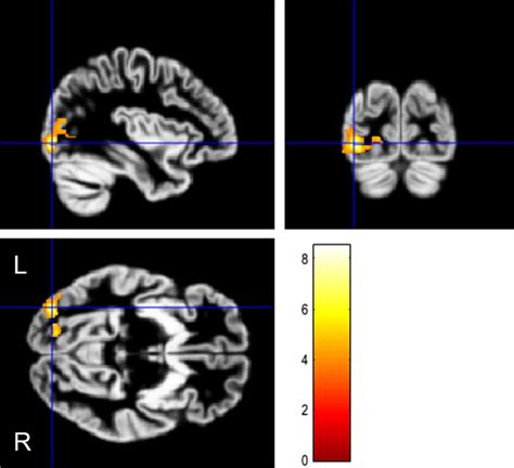 VBM Analysis With Small Volume Correction Restricted To The Occipital