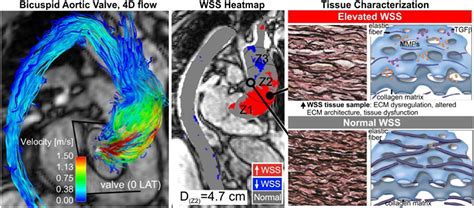 Frontiers Evolution Of Precision Medicine And Surgical Strategies For Bicuspid Aortic Valve