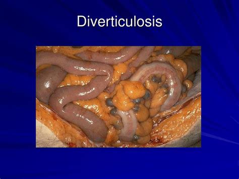 Ppt Inflammatory Bowel Disease Diverticulitis And Inflammatory Bowel Disease Powerpoint